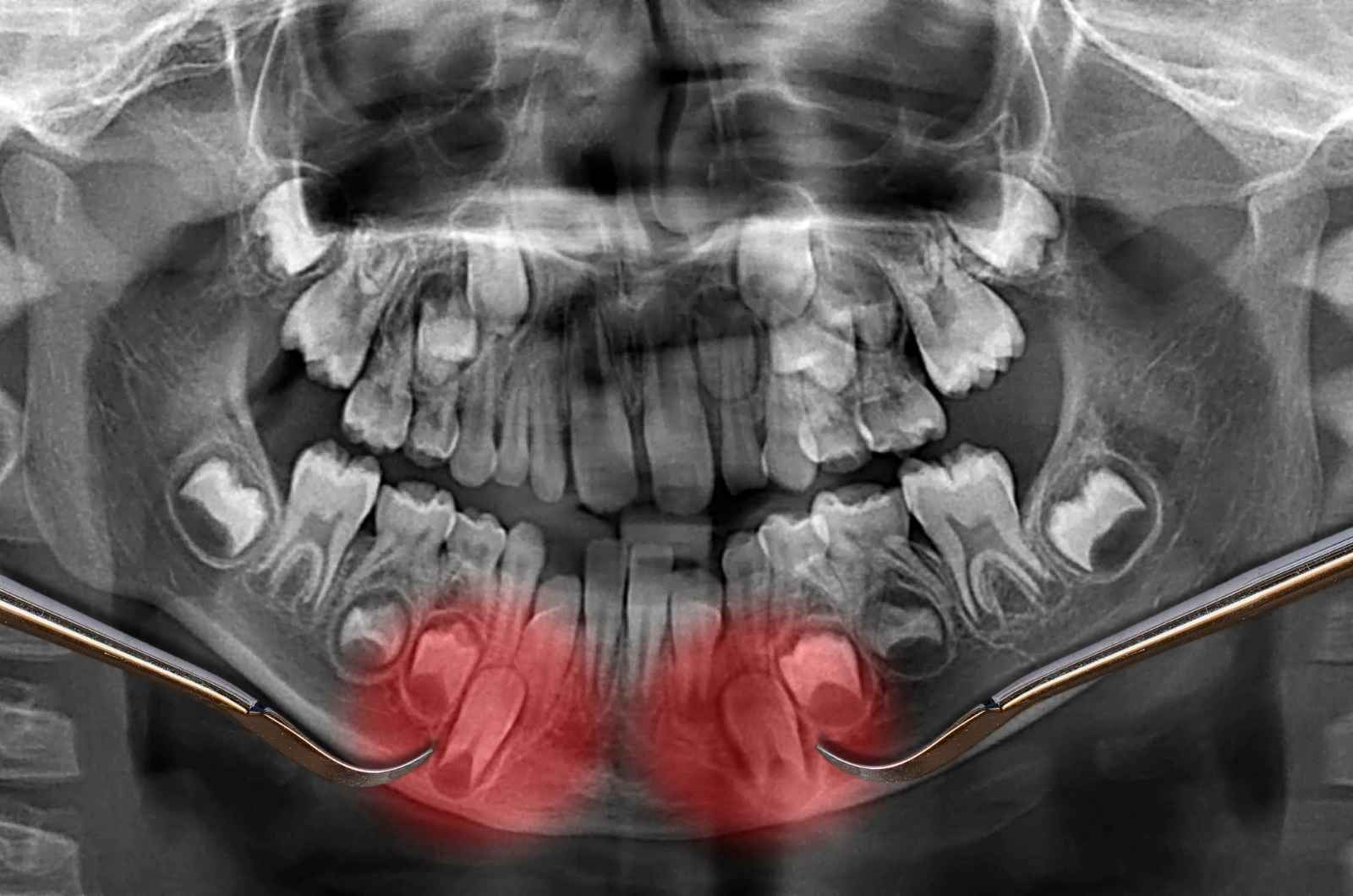 Mobile Dental CT Scans